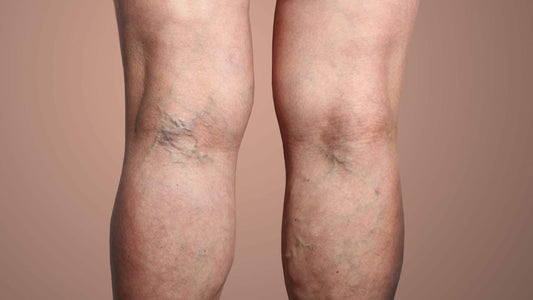 7 home remedies for varicose veins you may want to try